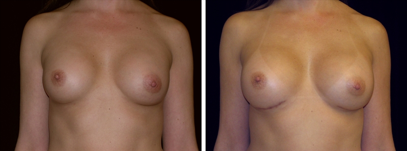 Breast Revisions in Thailand