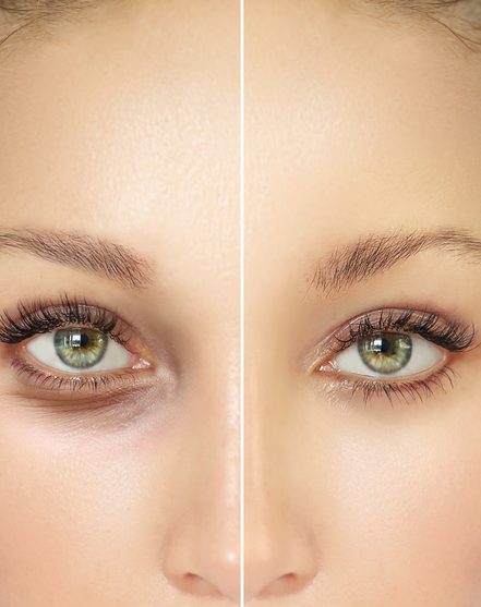 Eyelid Surgery in Thailand